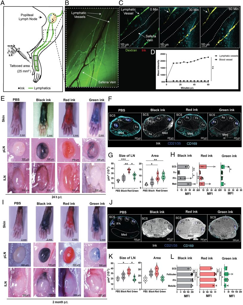 El Misterio Del Tatuaje Que Desapareció Mientras Destruía La Piel Intriga A Médicos 2 Migración de tinta y respuesta inmunológica
